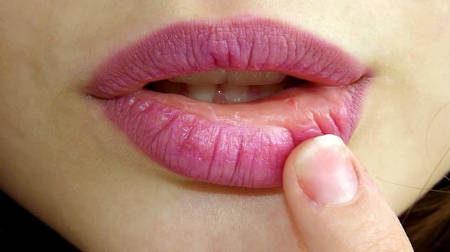 heal lips sores